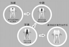 儿童出现龋齿怎么防治？