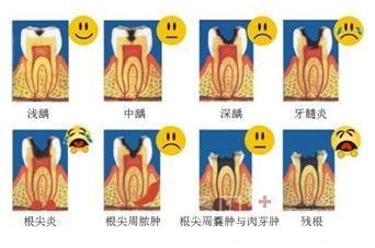 如何预防和治疗龋齿？