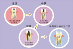 龋齿会给孩子带来哪些危害