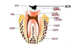 儿童发生龋病的原因？
