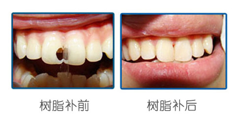 蛀牙治疗前后对比