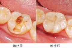 儿童蛀牙很痛怎么快速止痛