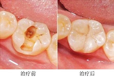 蛀牙补牙过程