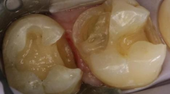 儿童蛀牙怎么治疗