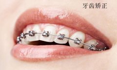 <b>做牙齿矫正怎么选择合适的医院呢</b>