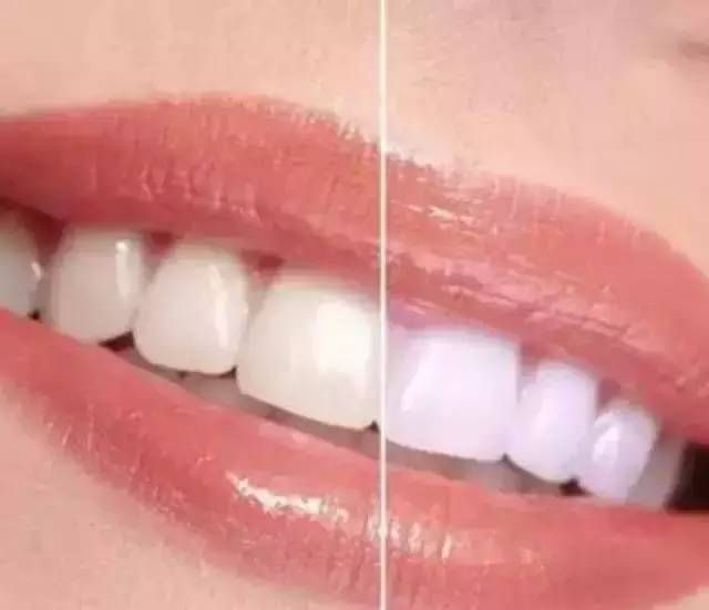 四环素牙美白