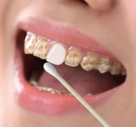 四环素牙用瓷贴面美白好不好
