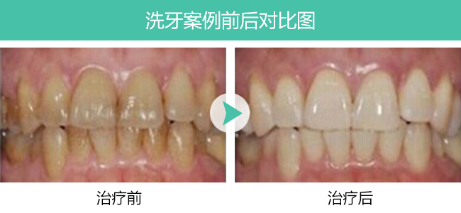 洗牙