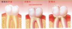 福州德尔齿科教您预防牙周炎