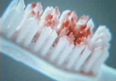 牙周炎不治疗有哪些严重危害?