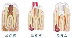 根管治疗效果好吗?