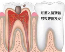 做完根管治疗可以不戴牙套吗？