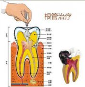 做根管治疗具体有哪些步骤？