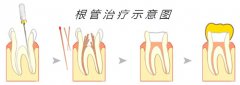 德尔齿科的根管治疗疼不疼