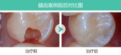 牙齿龋坏治疗一次就好了吗