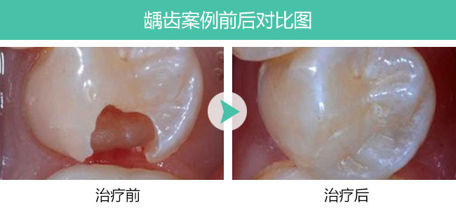 龋齿