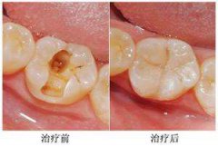 儿童有蛀牙补牙治疗要多少钱