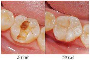 蛀牙补牙治疗