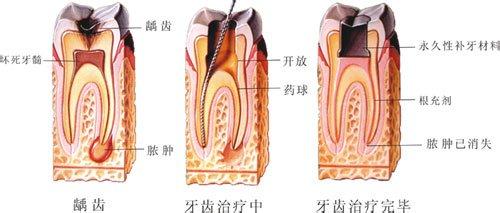 牙髓炎做根管治疗