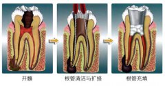 牙髓炎的疼痛是什么样的感觉
