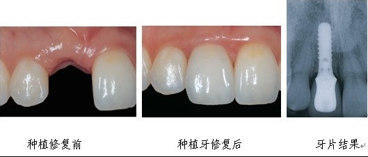 门牙缺失
