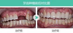 老人牙齿掉了几颗该怎么办