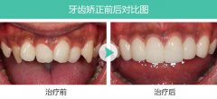 矫正虎牙有哪些方法