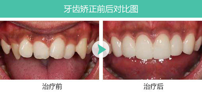 虎牙