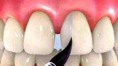 牙齿缝隙大用哪种矫正方法