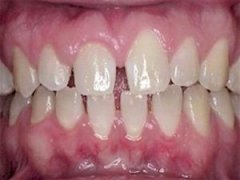 治疗牙齿稀疏有哪些方法