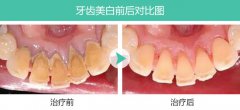 什么方法清除牙结石比较好