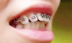 <b>牙齿矫正的方法技术该怎么选择呢?</b>