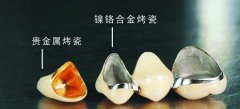 <b>福州哪里可以做钴铬合金烤瓷牙</b>