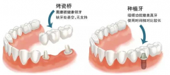 后牙缺失怎么修复