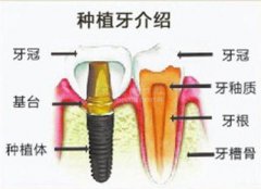 半口牙缺失用什么方法修复好