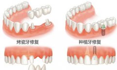 多颗牙缺失该怎样修复